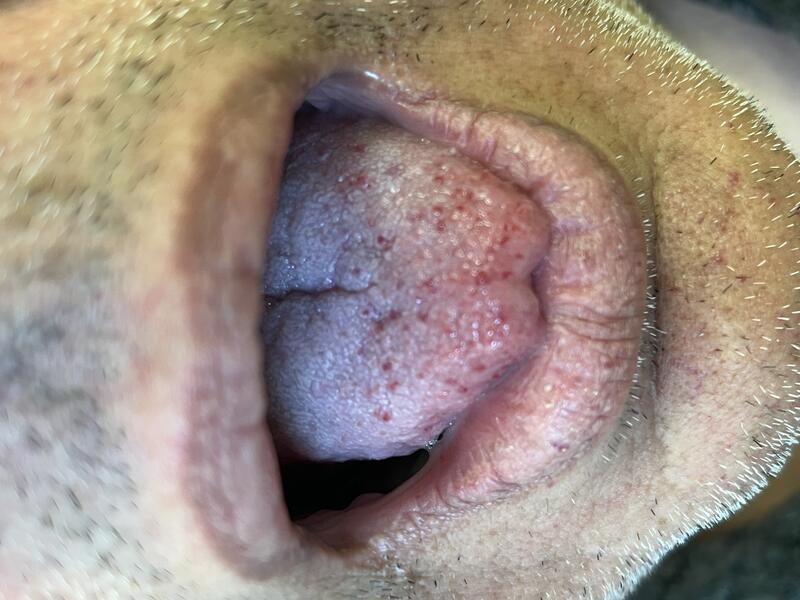 Teleangiektasie Beispiel 1