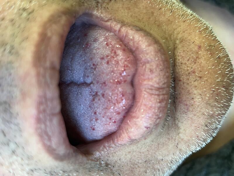 Beispiel für Nasenbluten bei Morbus Osler